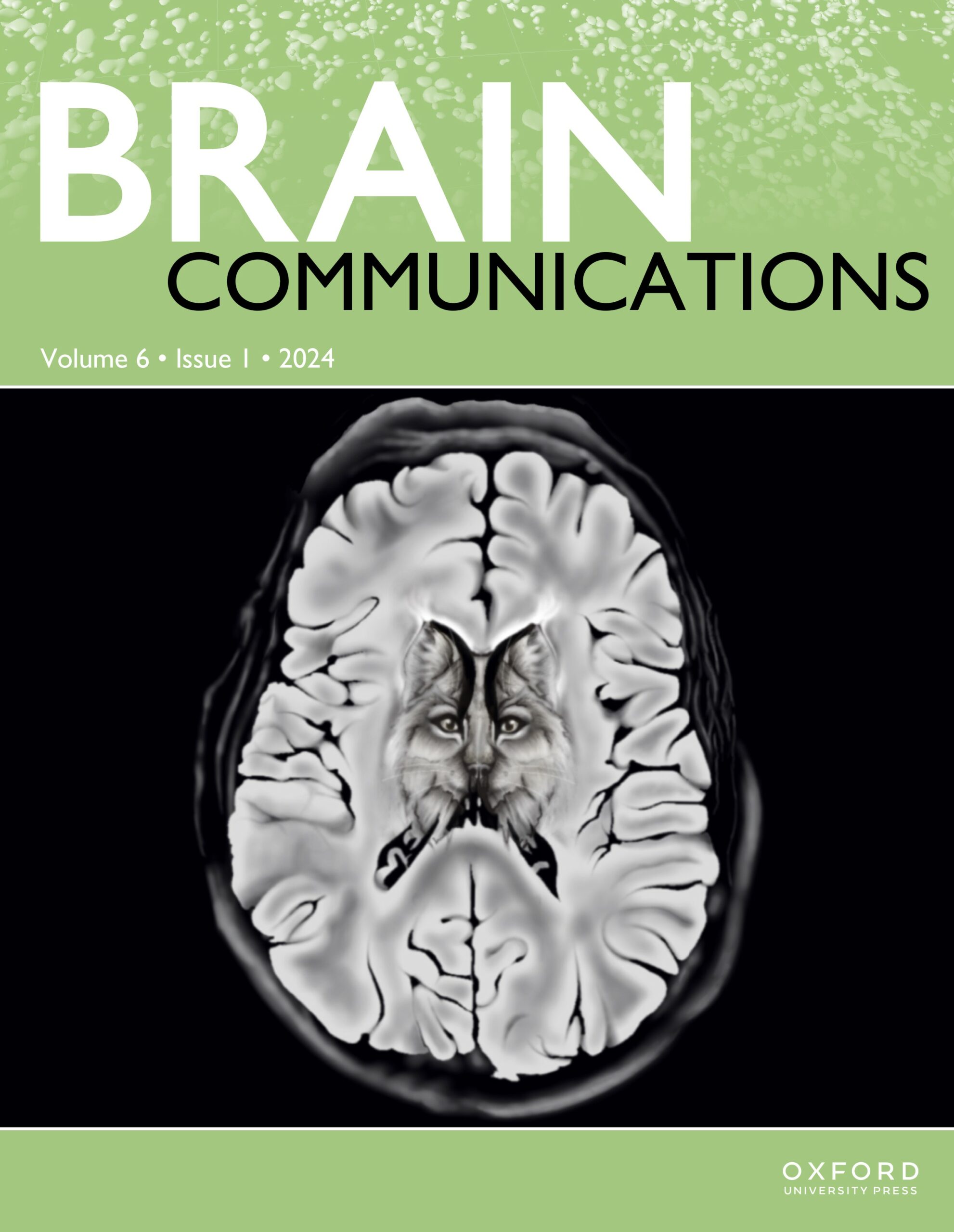 Tau accumulation and its spatial progression across the Alzheimer’s disease spectrum. (St-Onge F. et al., 2024)